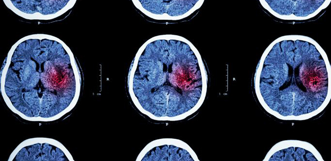 New stem cells promising stroke treatment