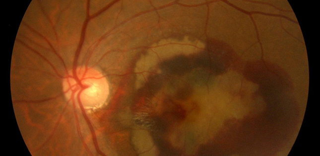Reproducing a retinal disease on a chip