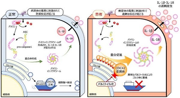 CDC C末端異常症に於ける炎症病態を解明    プレスリリース・研究