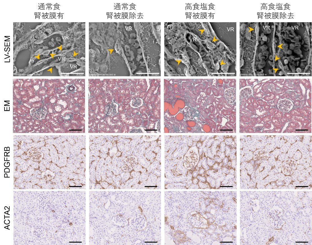 腎うっ血による腎障害機序の一端を解明 ～ヒト腎臓で