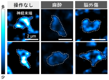 忘れる記憶、残る記憶。その違いを解明 ―麻酔や脳震盪で起こる「部分的な記憶喪失」の仕組みー