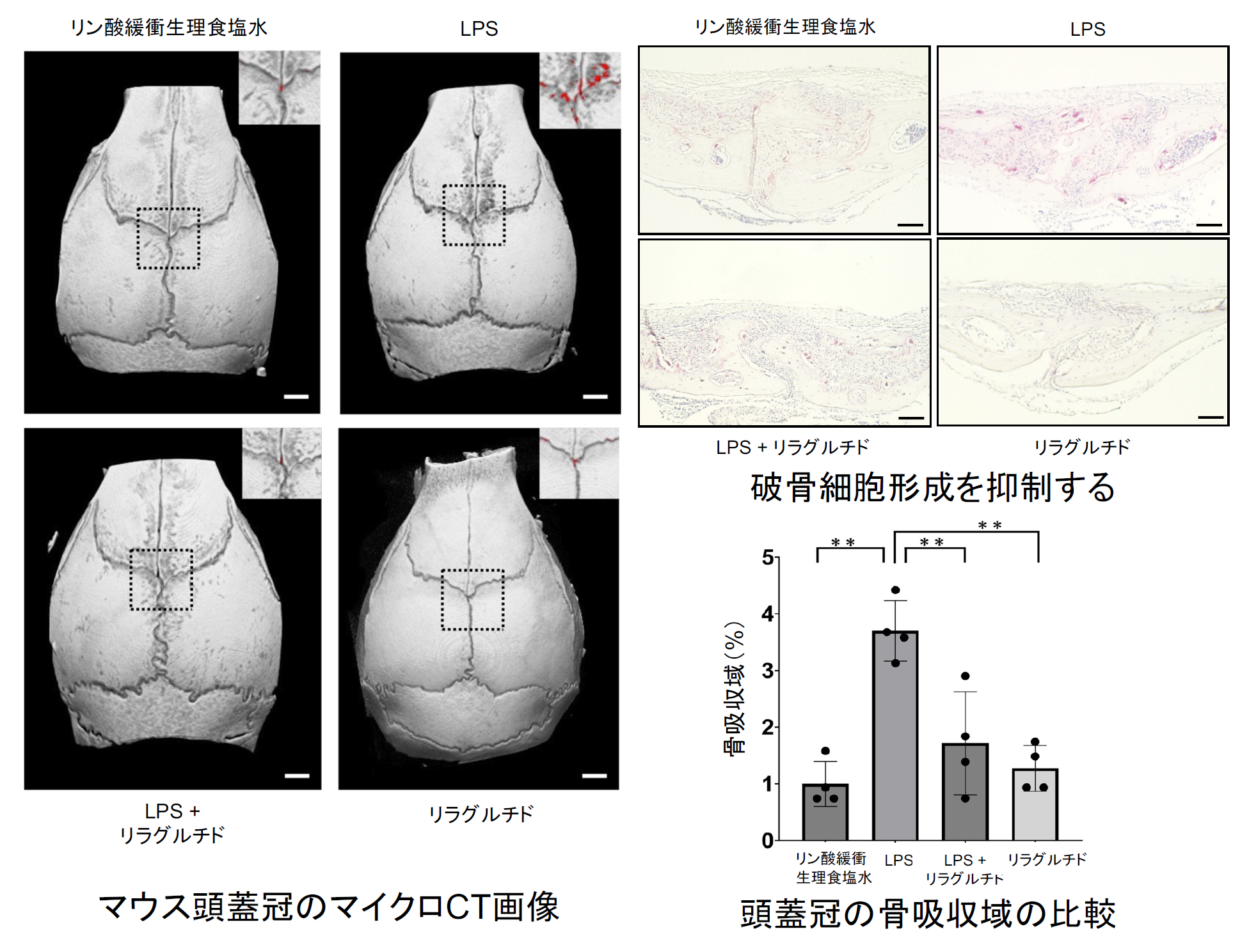 糖尿病治療薬リラグルチドが炎症による骨吸収を抑制 ―骨代謝をコントロールする新メカニズムを解明―