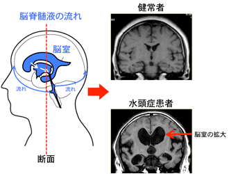 症 水頭 正常 圧