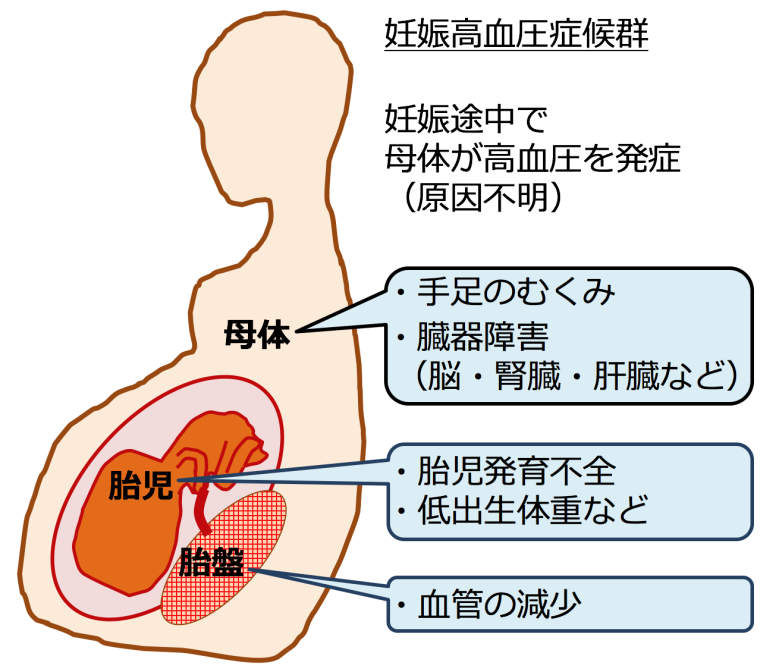 妊娠高血圧症候群