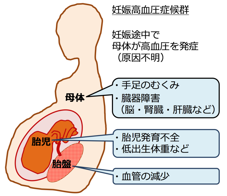 妊娠高血圧症候群 